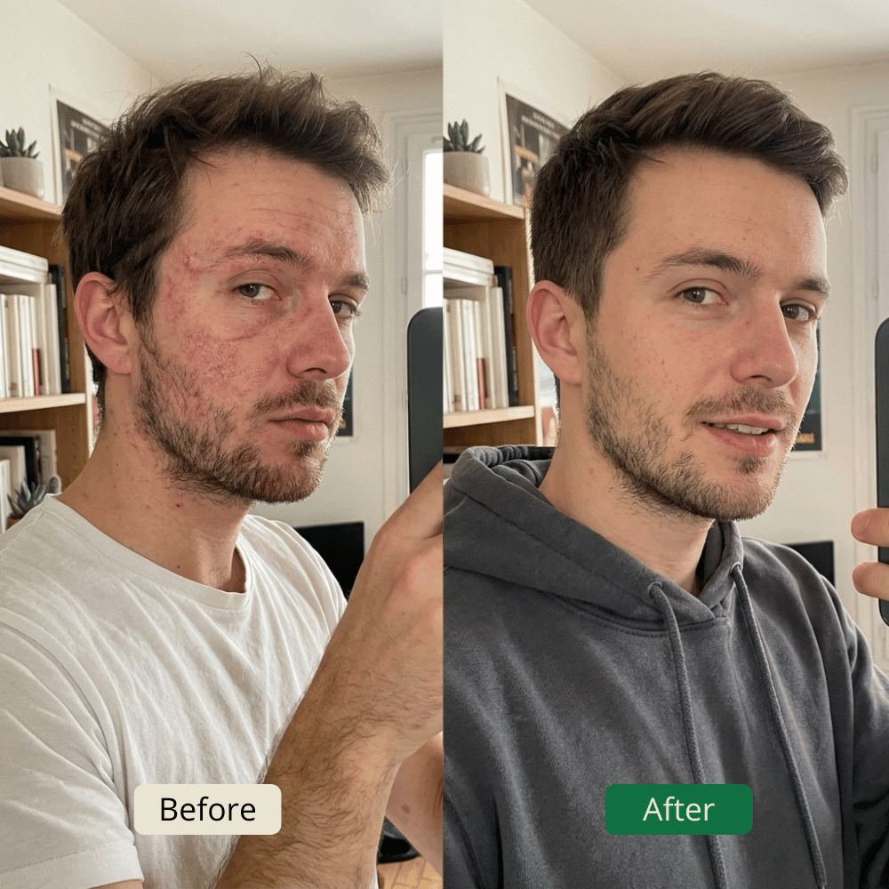 How to Get Rid of Eczema Naturally (Without Harsh Chemicals) Image